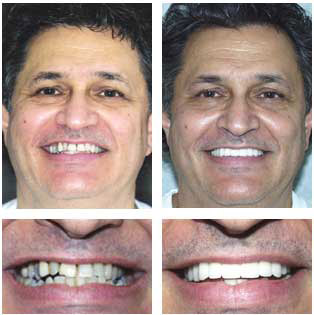 Marc Marc- Porcelain Veneers, Bridge and Crowns