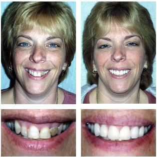 Terry Tery - Porcelain Veneers and All Porcelain Crowns