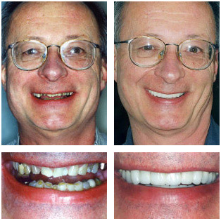 Bob Bob- Full Mouth Reconstruction with Crowns and Bridges