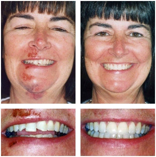 Diane Diane - 4 Porcelain Veneers