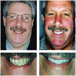 Ed Ed - Porcelain Veneers