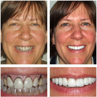 10 10 Porcelain Veneers