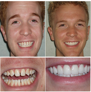 11 J.P. - 8 Porcelain Veneers