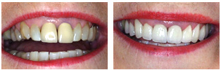Jane Jane- 8 Porcelain Veneers and 2 Crowns