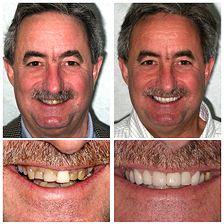 featured_patient_pollack Smile Makeover with Porcelain Veneers