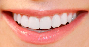 veneers