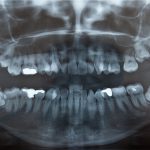 Gum Disease Affecting More Americans Than Diabetes!
