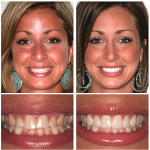 Am I a Candidate for Porcelain Veneers?