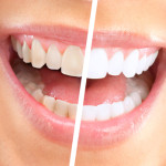 What is the Difference Between Over-the-Counter Whiteners and Professional Whitening Treatments?