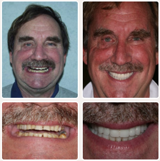 Dental Implant Before and After