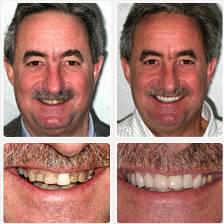 Implant Denture Before and After