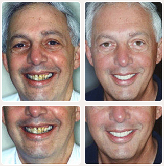 Implant Denture Before and After