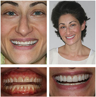 DURAthin® No-Prep Veneers Before and After