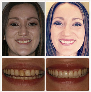 Standard Prep Veneers Before and After